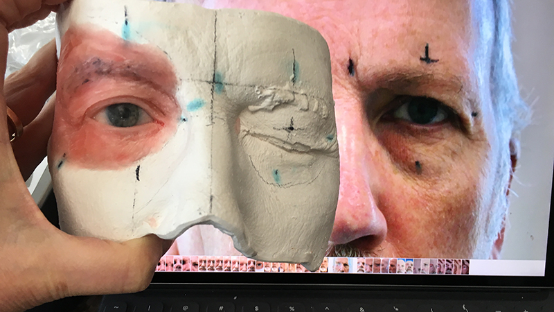 Sculpting an orbital prosthesis with wax