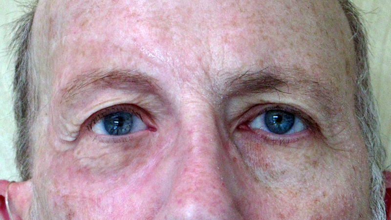 Right orbital prosthesis attaches with skin adhesive, restores eye, eyelids, and eyebrow