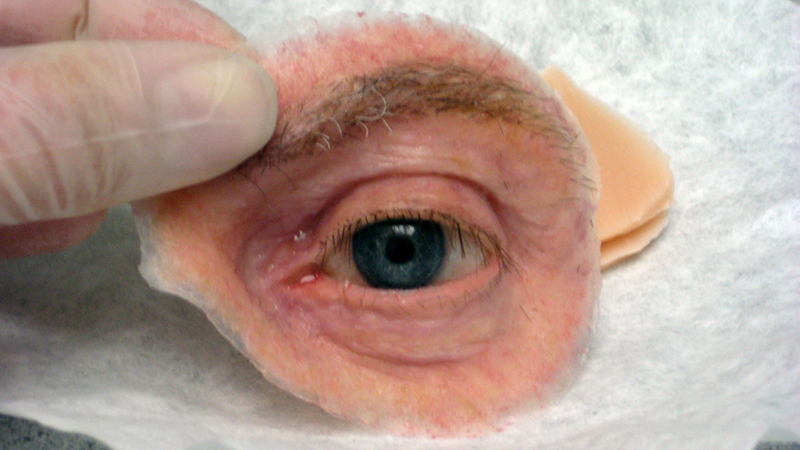 Silicone orbital prosthesis with eyebrow