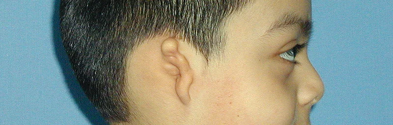 Prosthetic Ear - Ear Prosthesis - Microtia | Wisconsin — Life-like ...