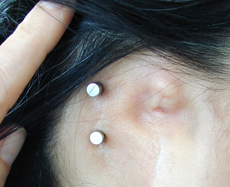 Anaplastology Julie Jordan Brown Megan Thomas — Lifelike Prosthetics