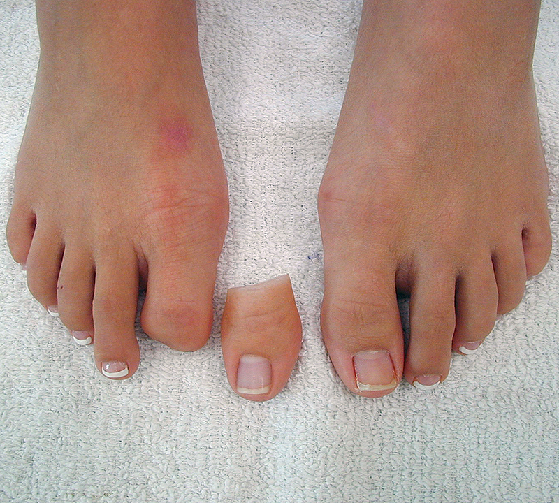 Toes and Toestumps #amputee #toe