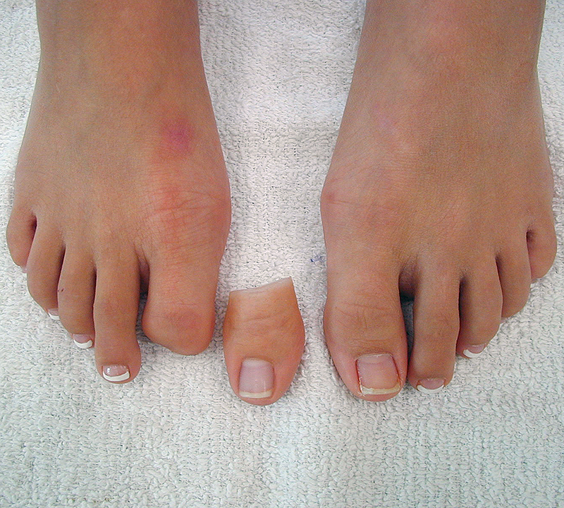Toe Prosthesis - Partial Foot 