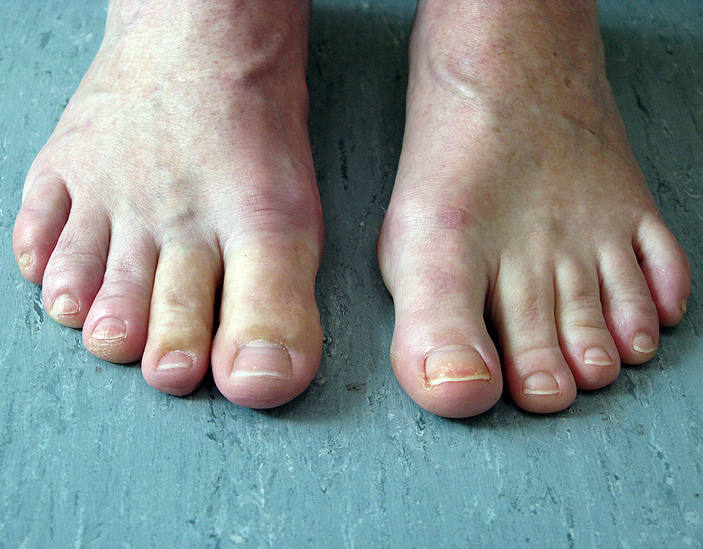 Great and second toe prostheses rely on suction to stay in place securely