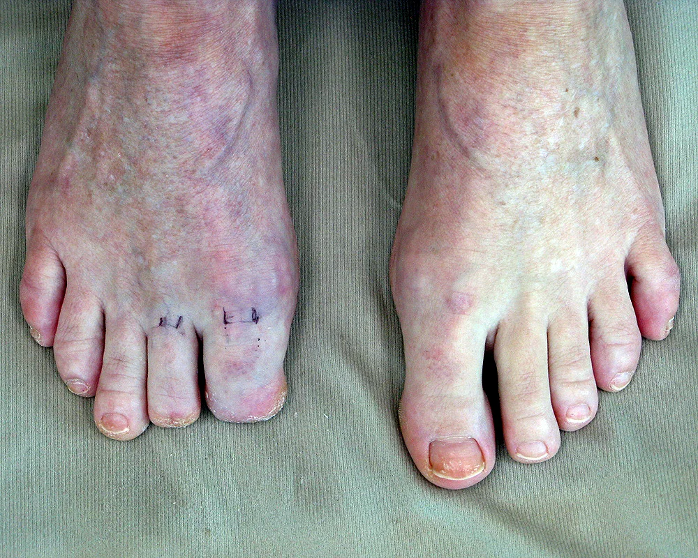 Toe Prosthesis Milwaukee — Lifelike Prosthetics