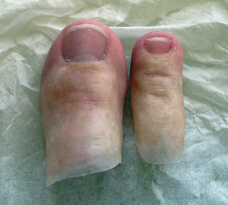 Custom silicone great and second toe prostheses with acrylic toenails 