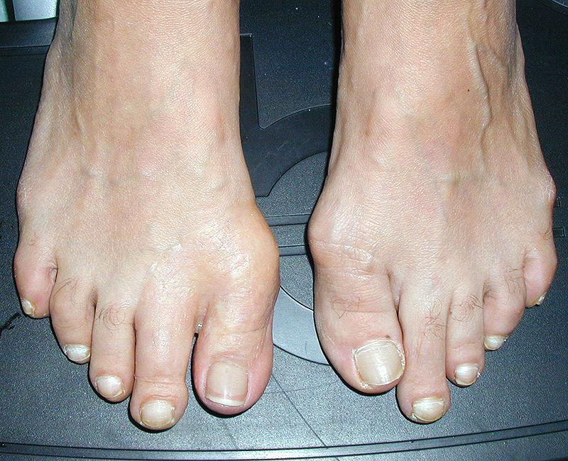 When toe loss is complete, the prosthesis may wrap around the adjacent toe for secure retention 