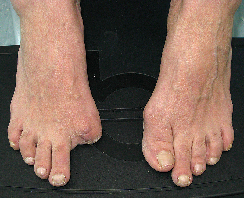 When toe loss is complete, the prosthesis may wrap around the adjacent toe for secure retention