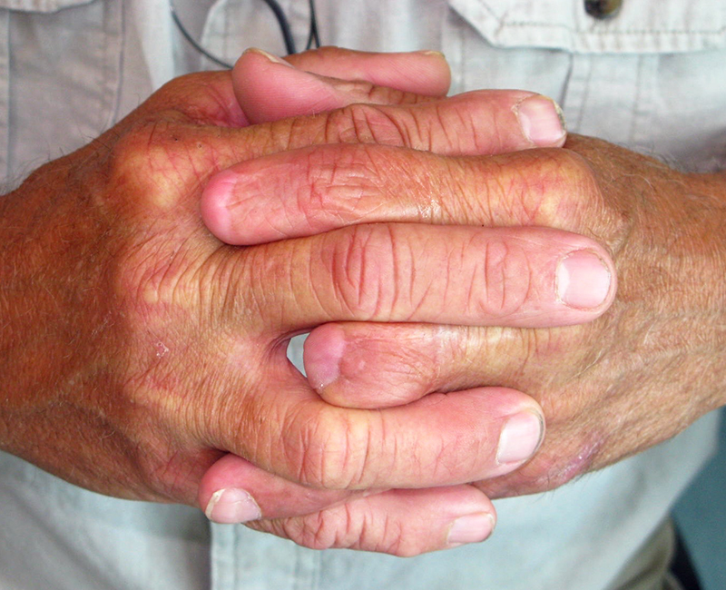 Injury to left index and middle fingers - hand injuries often affect multiple fingers