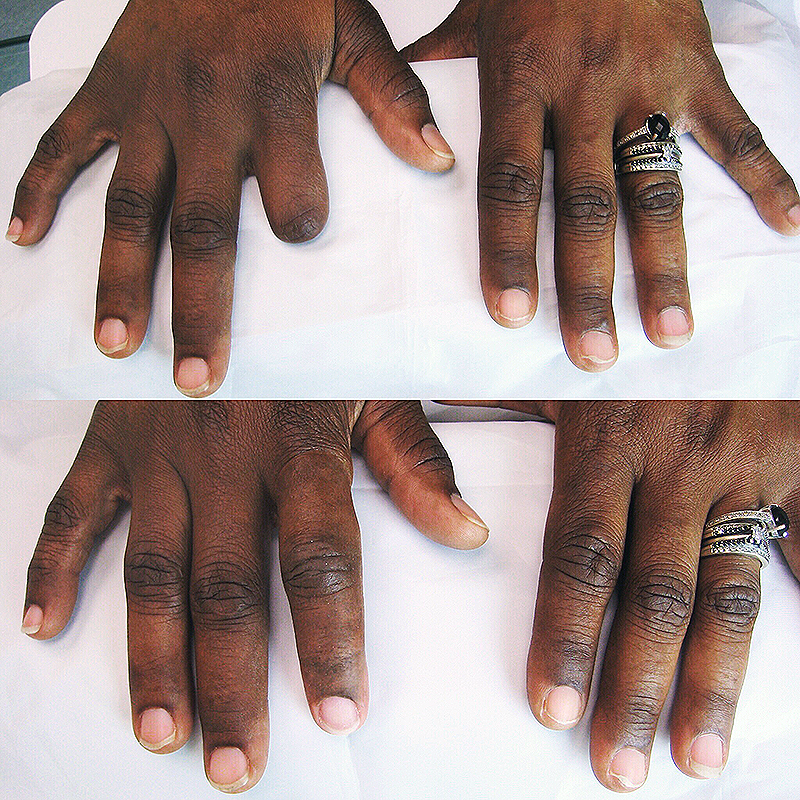 Finger Prosthesis - Hand Prosthesis | Milwaukee, WI — Life-like Prosthetics