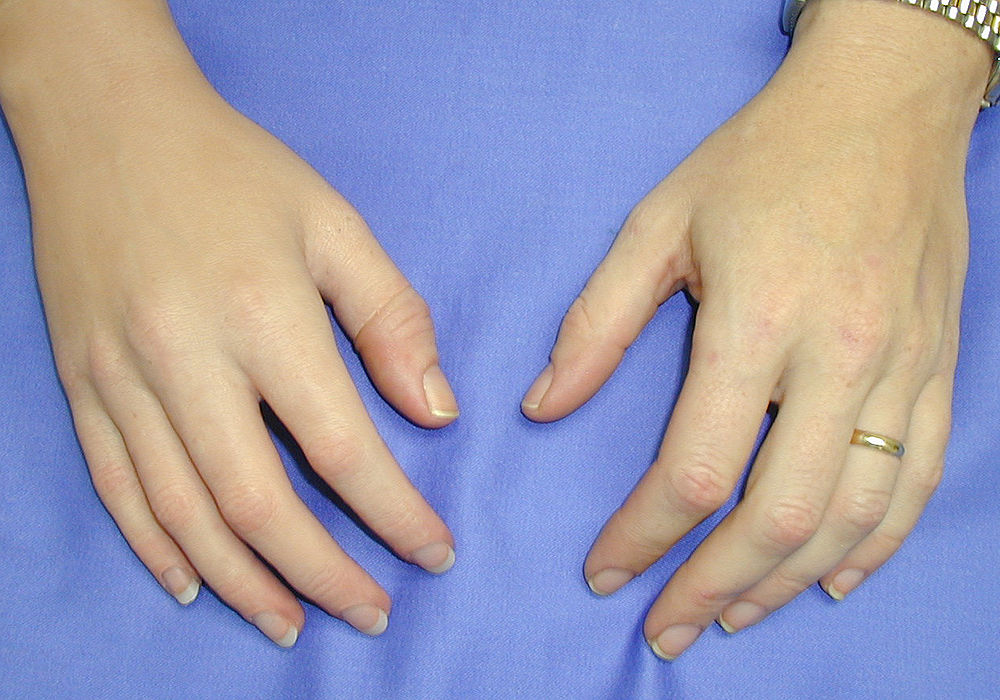 When finger loss is complete, a glove-style prosthesis may provide the most secure attachment 