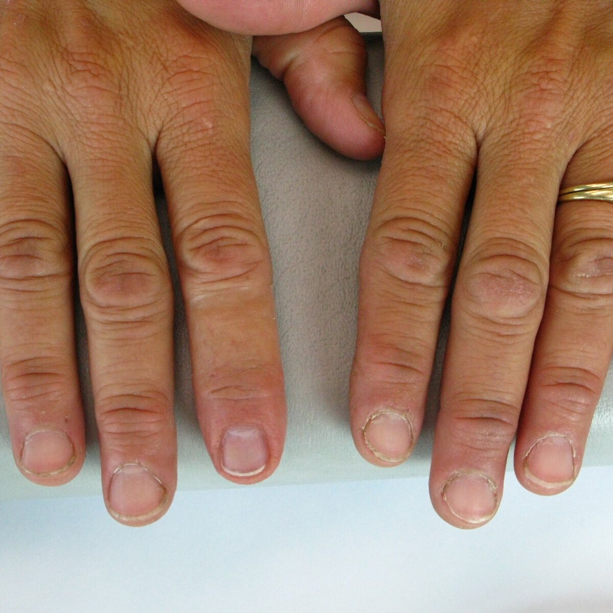 Custom silicone index fingertip prosthesis 