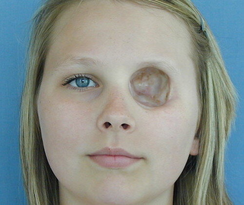 An orbital prosthesis restores a missing eye and eyelid after surgery to remove cancer