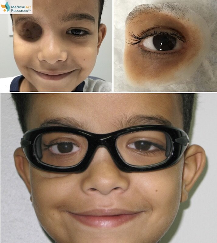 Orbital Prosthesis Photos - Prosthetic Eye and Eyelids — Life-like  Prosthetics