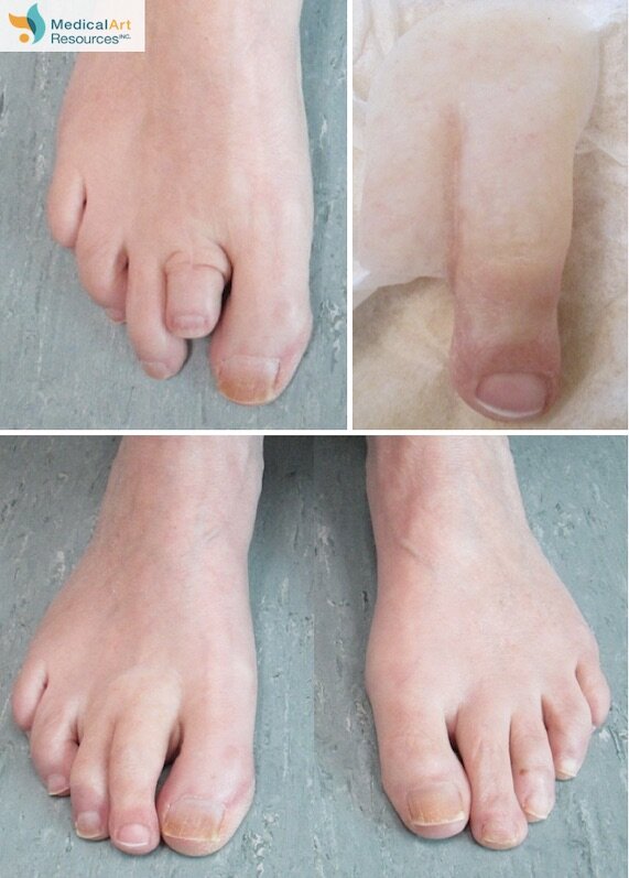 Foot Restorations - ALTERNATIVE PROSTHETIC SERVICES