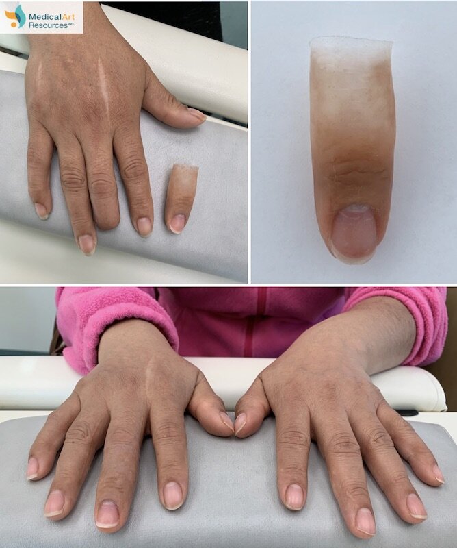 Finger and Hand Prosthesis Photos  Medical Art Resources — Life