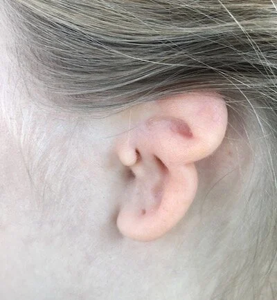 Left microtia and atresia