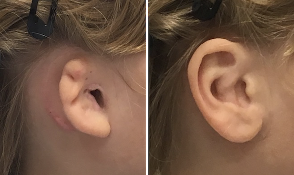 Silicone prosthetic ear over microtia with canalplasty. 