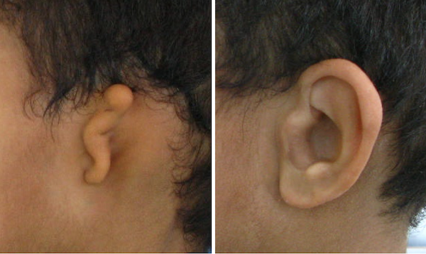 Auricular (ear) prosthesis over microtia and atresia. 