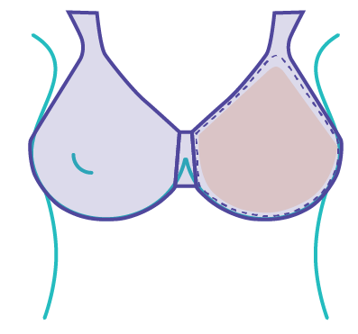 Standards of care for breast prosthesis and bra-fitting services