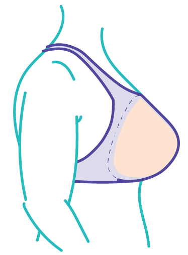 Breast Prosthesis - Nipple Prosthesis - Post-mastectomy Care