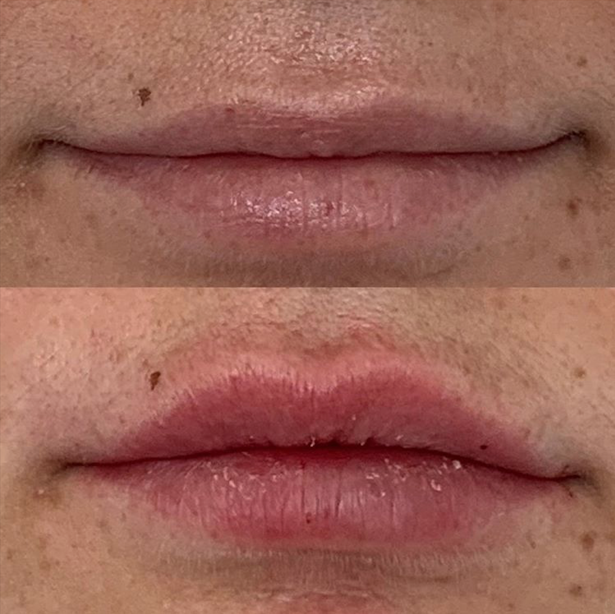 Before and after 1 syringe lip filler.