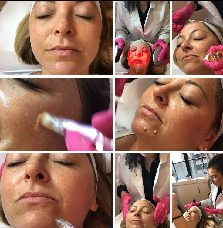 BB Glow Facial after just ONE session!