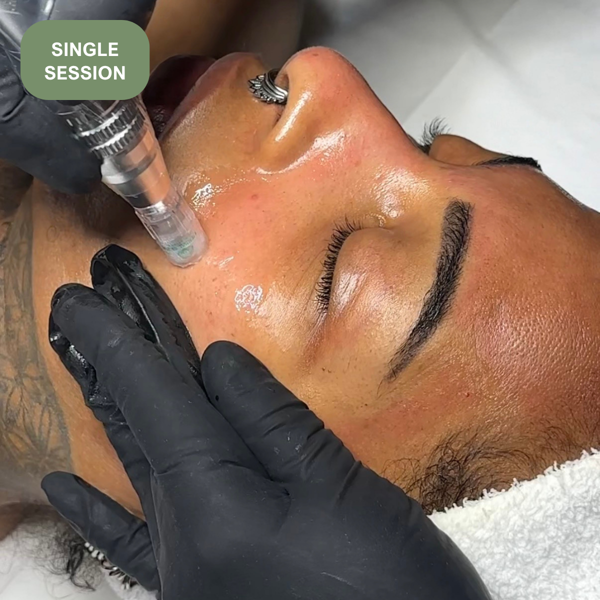 Microneedling: Single Session