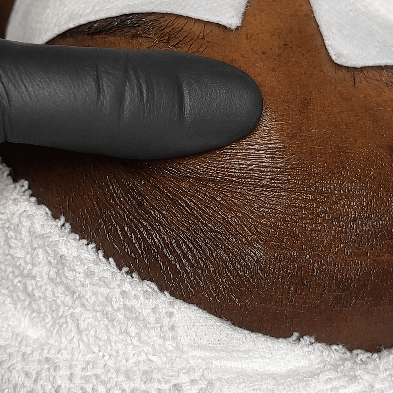 Close-up of melanin-rich skin during a facial showing crepey texture and fine dehydration lines while the skin is gently stretched with a gloved finger.