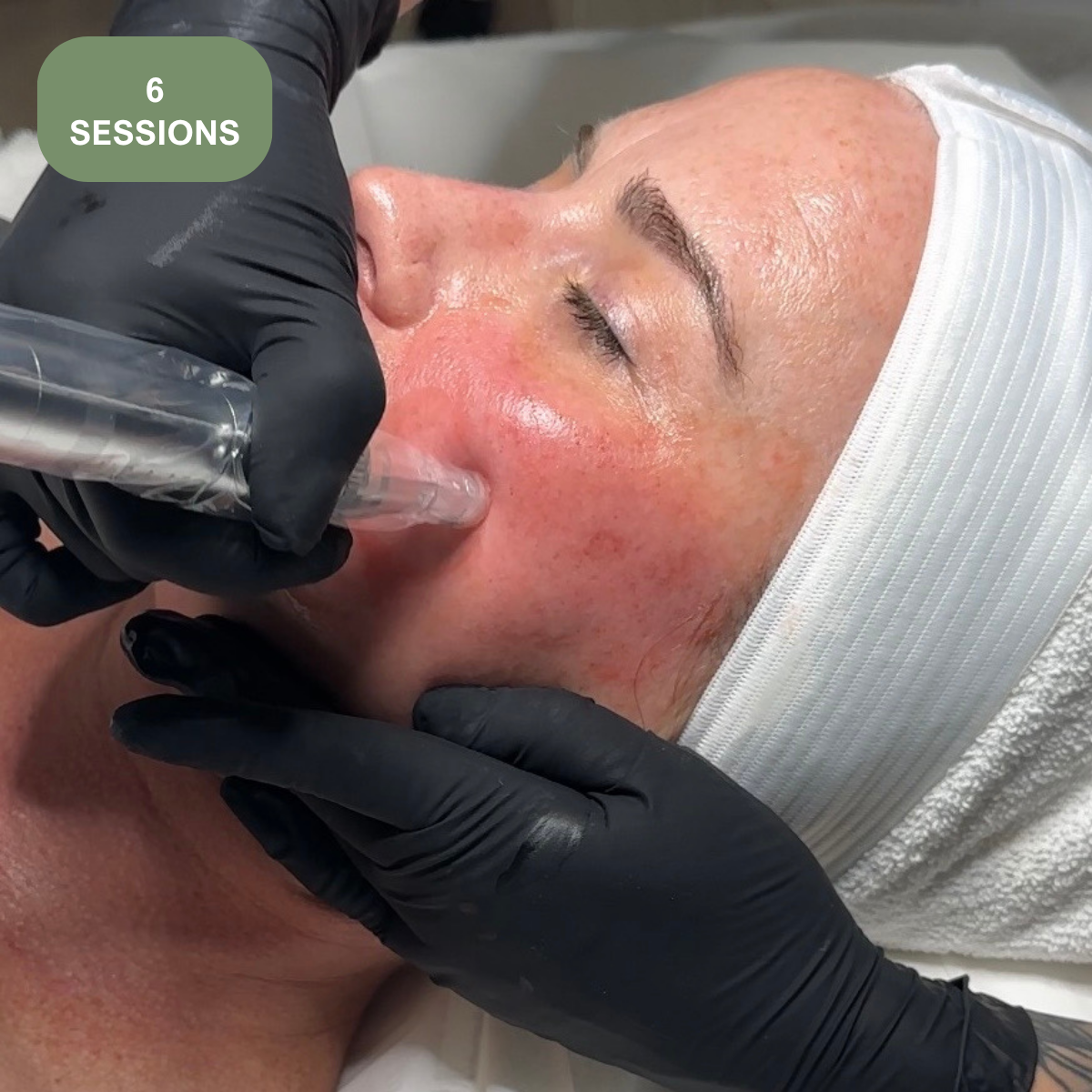 Microneedling: Series of 6