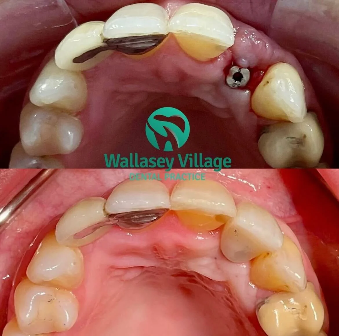 Before and After Dental Implants.jpg