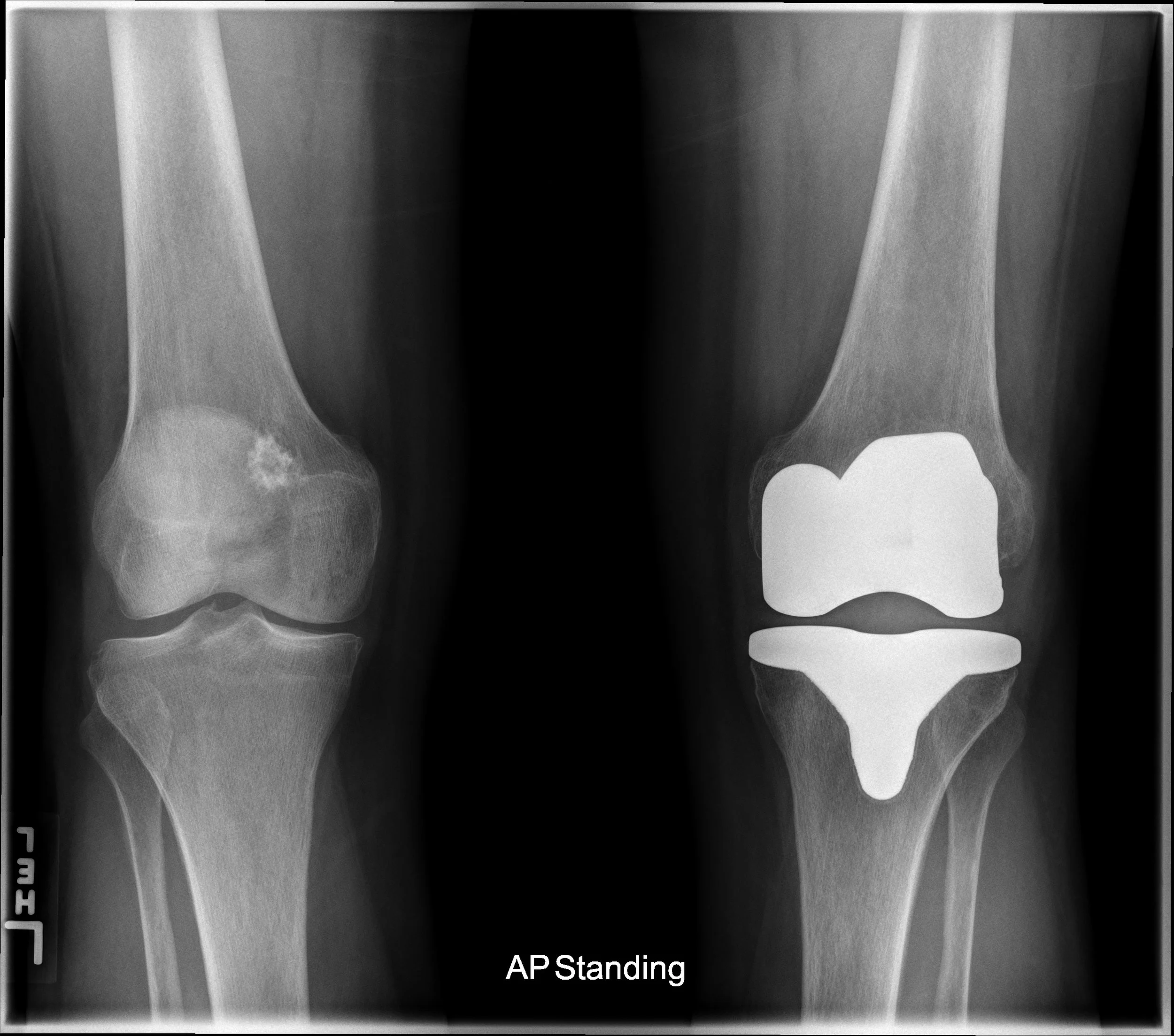 Case 167 Benign vs. malignant bone mass — DartRad