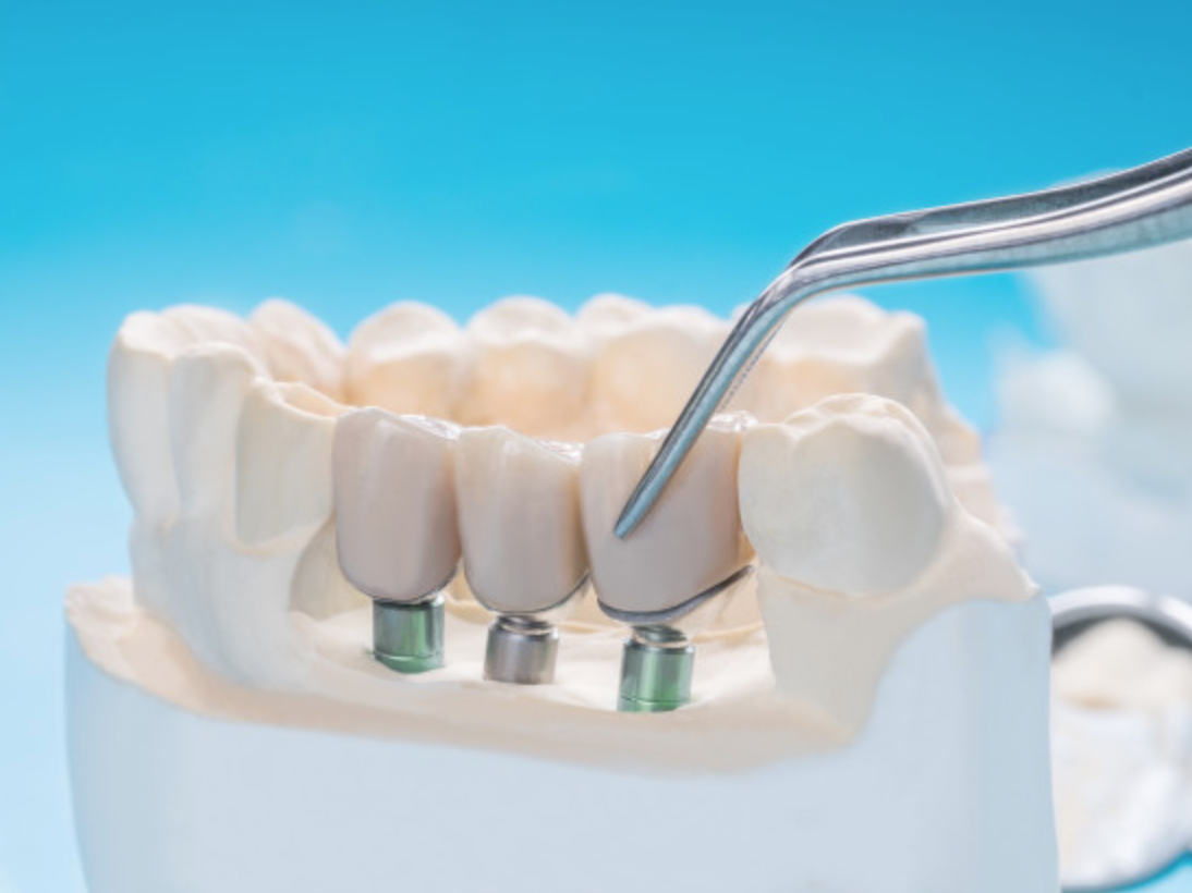 Masterclass Indirecte Restauraties