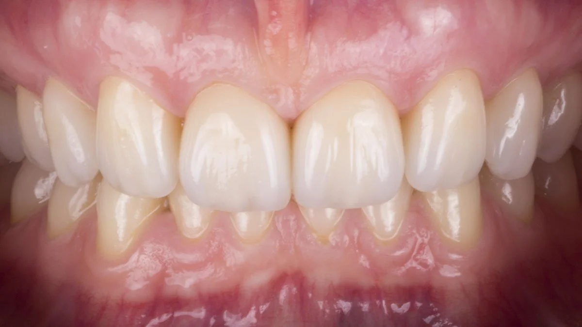 Hands-on Masterclass Prep vs. Non-prep Facings