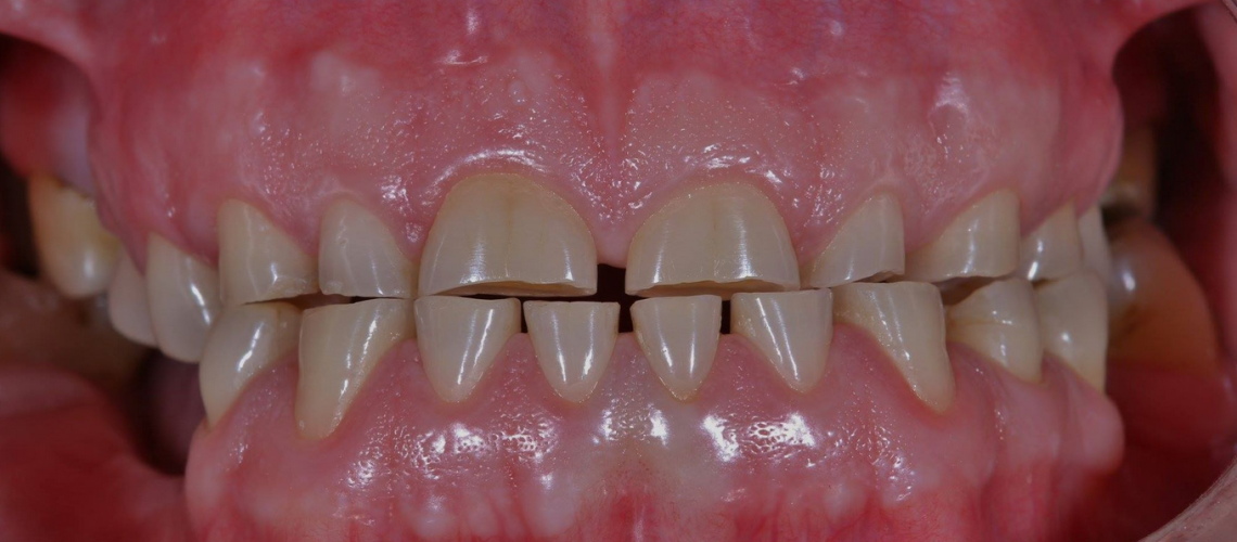 Masterclass Slijtage & Occlusie