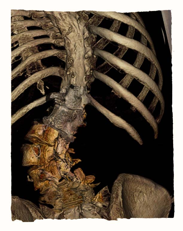  In Photoshop, I layer together a composite image to help me set up the anatomy for the new piece.  First, a set of images from my 3D CT scan.  In the lumbar area, I’ve cropped away the most posterior part of the vertebrae, the spinous processes, to 