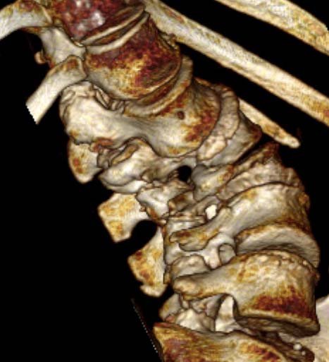 3D CT scan image of lumbar spine