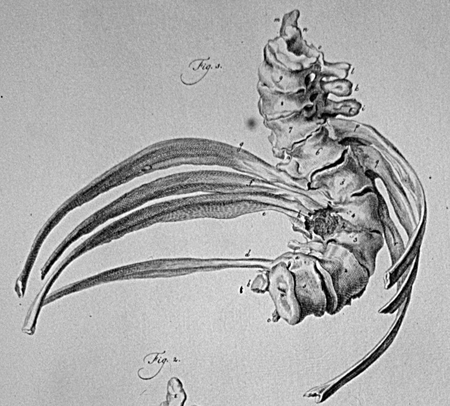 Eduard Sandifort, scoliotic vertebrae and ribs