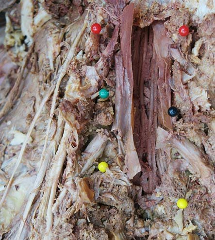 Dissection of lumbar spinal cord (cauda equina)