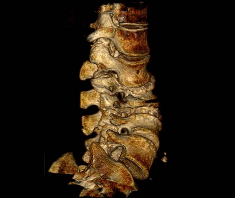 3D scan image, right/anterior view of foraminal openings from T12 to sacrum