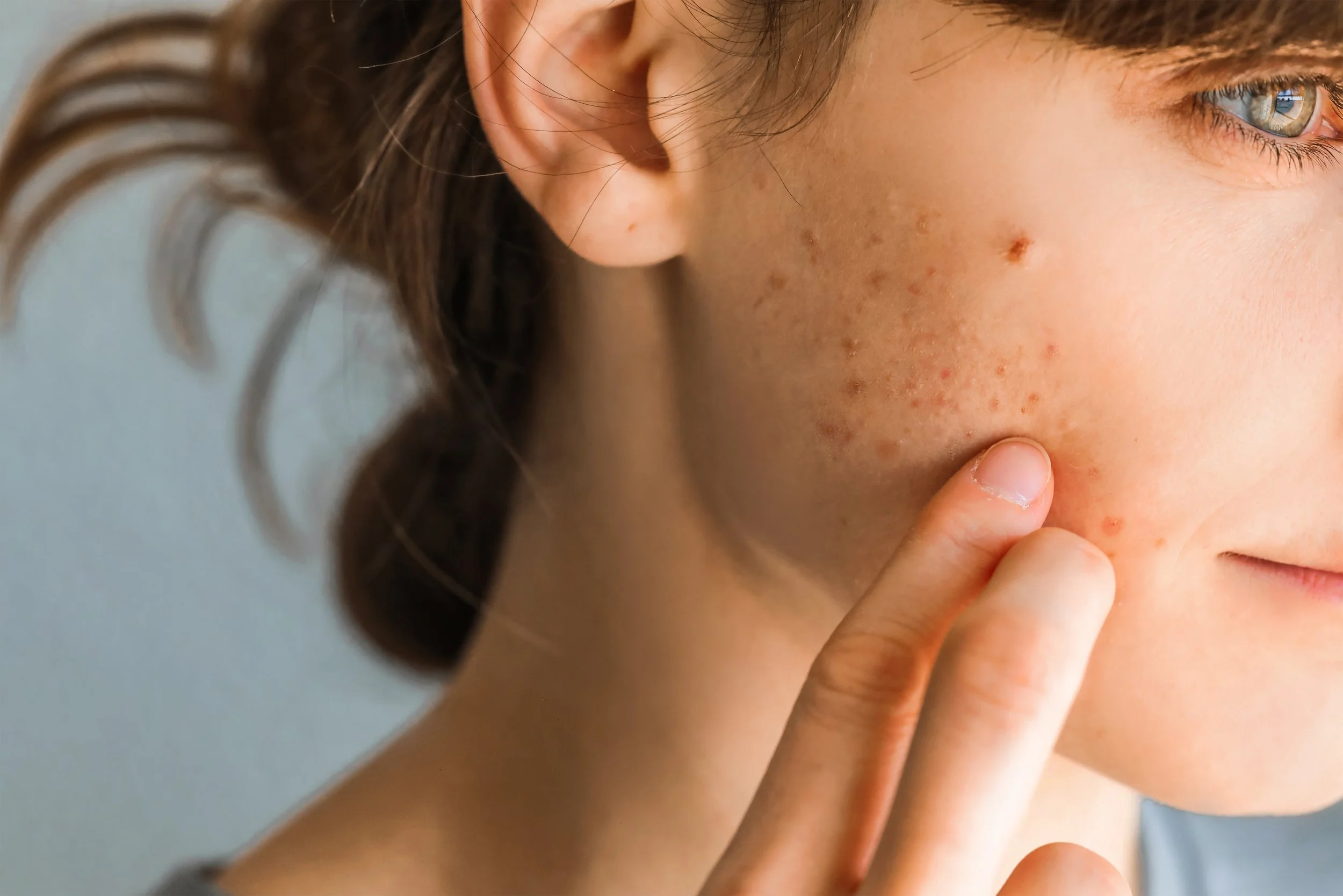 Teenage Skin Problems and How SOS Can Help