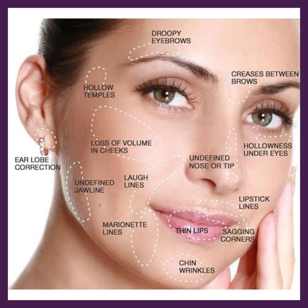 When people think of fillers, they often think of lip and cheek treatments. However, dermal fillers can be used to fix a variety of cosmetic concerns. This face map shows the various problem areas that fillers can be used to treat. These treatments a