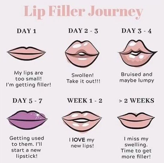 It&rsquo;s common for clients to miss the look of their lips after the swelling from their filler has gone down. Sometimes it&rsquo;s best to opt for a fuller lip in the office so that when the swelling subsides, they&rsquo;ve reached a fullness that