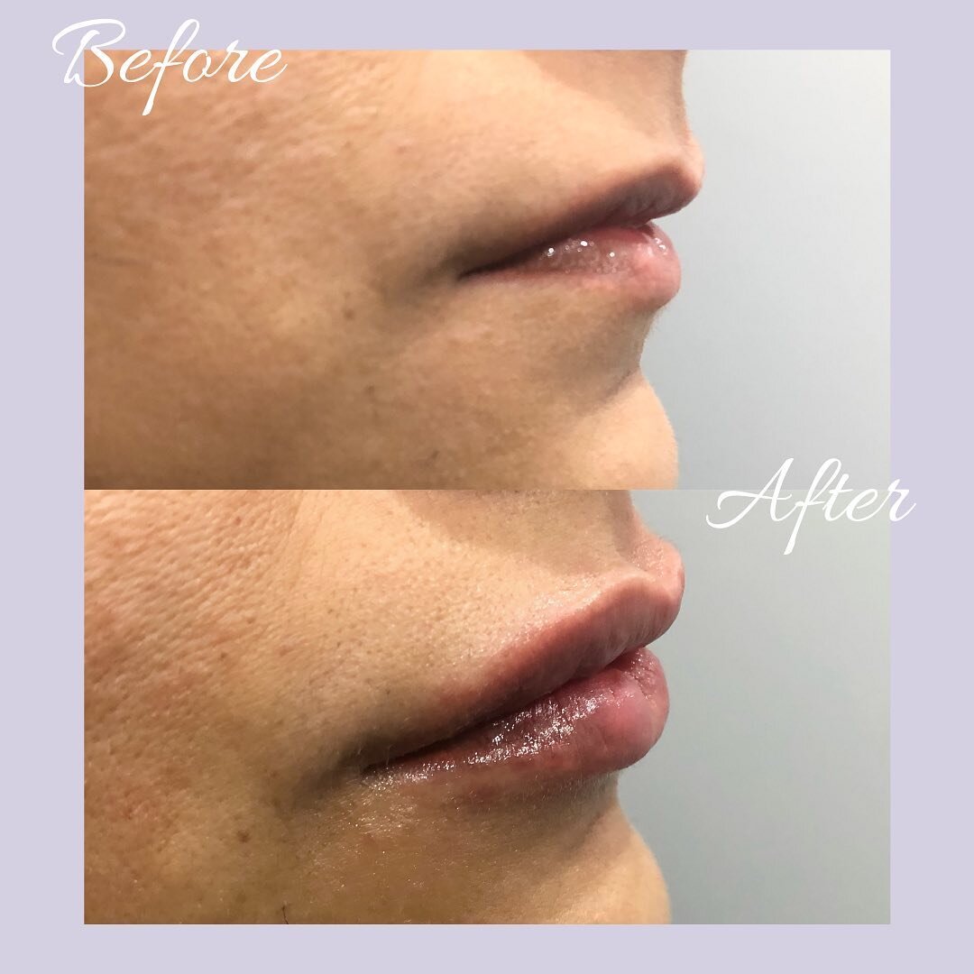 This patient received Dermal fillers from Dr. Naidu to increase volume and fullness in the upper and lower lip. These desired results can be seen especially when comparing the side profiles of the patient before and after treatment. The upper lip app