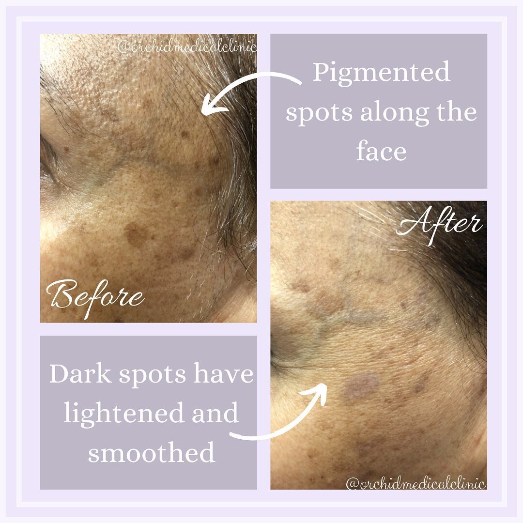 This patient received Acroma laser treatments to remove pigmented marks on her face. These spots lightened after 5-6 sessions and the skin texture improved. 

These laser treatments address a wide variety of concerns and can be very effective in impr