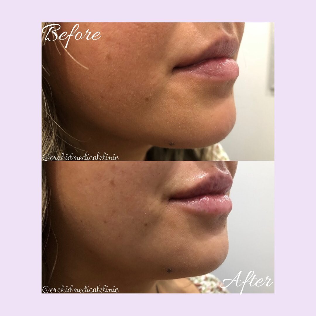 This patient came in for a lip filler touch up to replenish her look. She went for a subtle plump, adding a touch of volume to the upper and lower lip. Call the clinic to book a complementary consultation and receive expert advice on your cosmetic ne