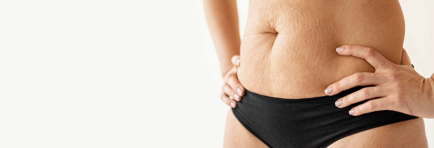 What Causes Cellulite & Where Is It Most Common?