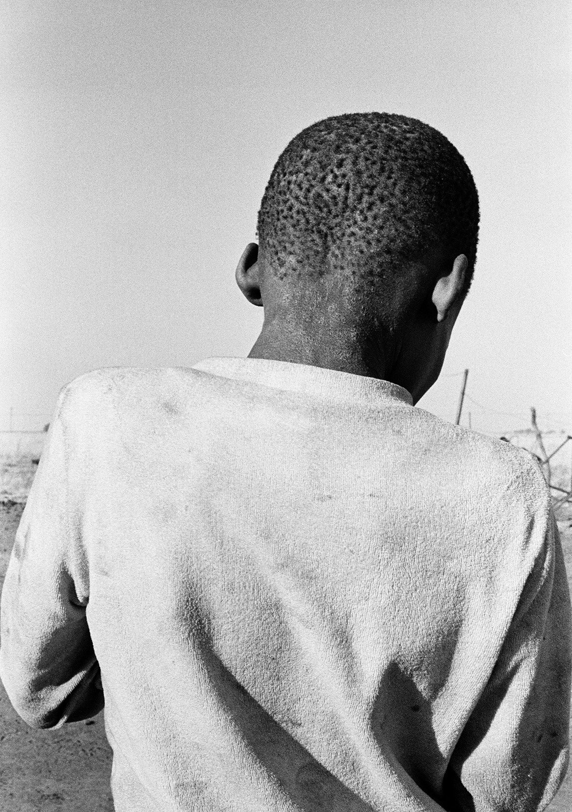  Tenego Tshabadira +/- 10 Years Old Suffering From Eczema, Vaalrand Farm, Bloemhof/ 1989 