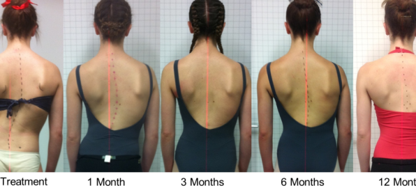 Scoliosis, Brace or Surgery?, Learn about your options & how to manage it