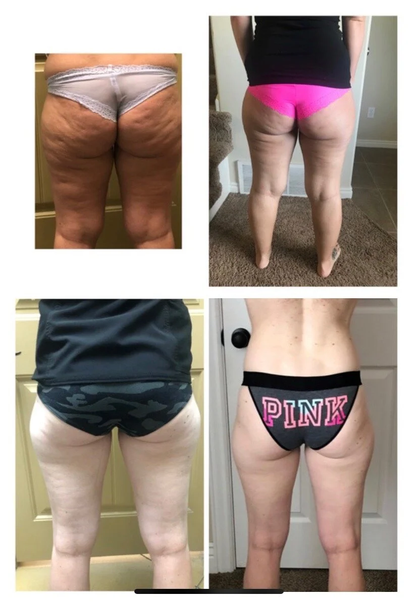 Ultrasound Cavitation Skinworks